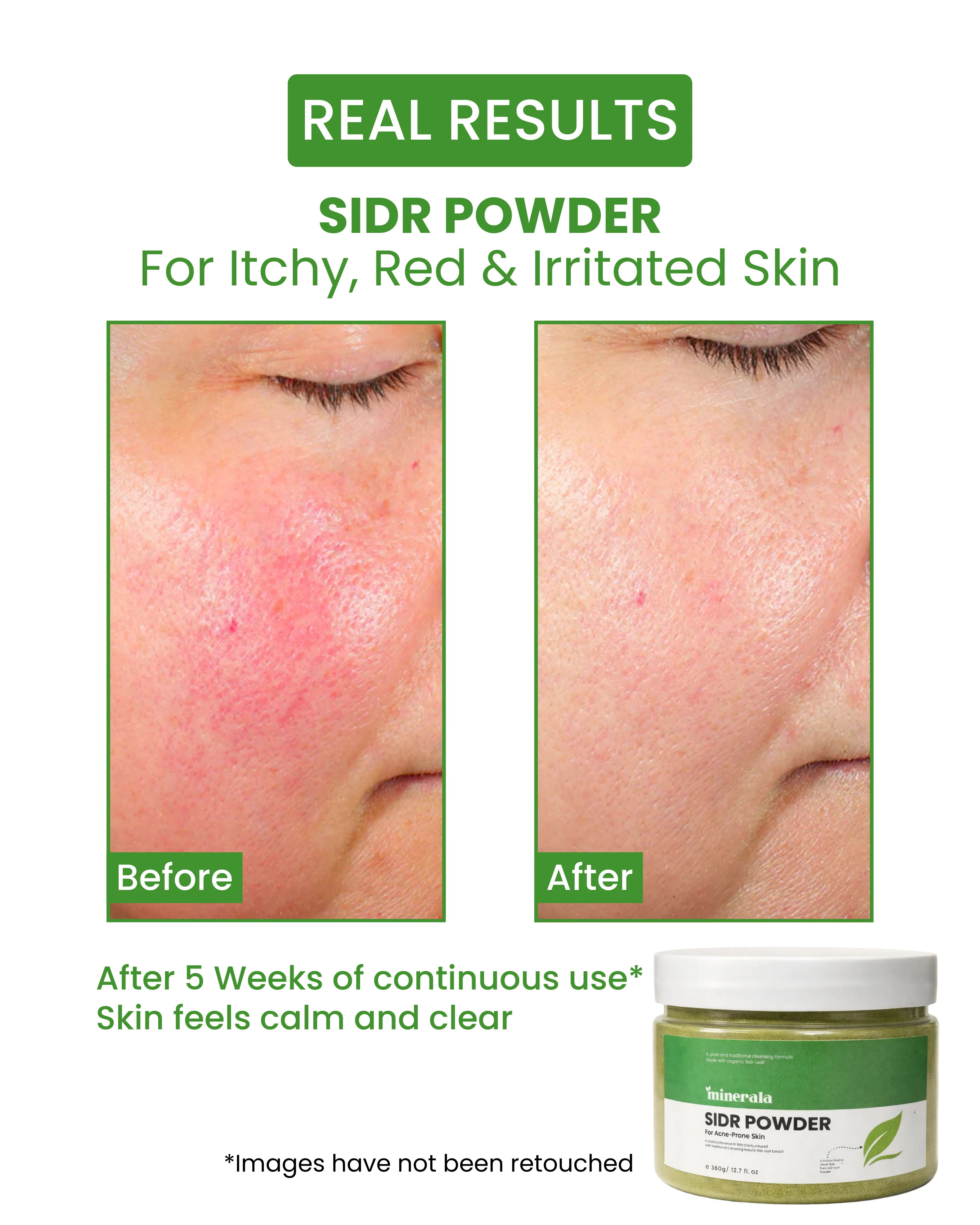 Sidr Powder (External Acne Cleanse Mask) - Image 3